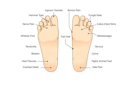 an illustrated image of two feet with lines pointing to and naming where ailments can occur on them