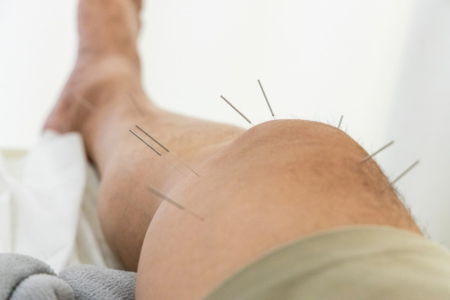male leg in doctors office with acupuncture needles in it
