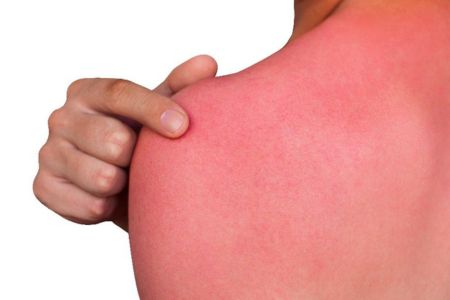 a Caucasian male sunburned back with him reaching back and pointing to the area